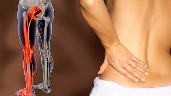 Đau thần kinh tọa là dạng bệnh do cơn đau kích thích dây thần kinh hông.