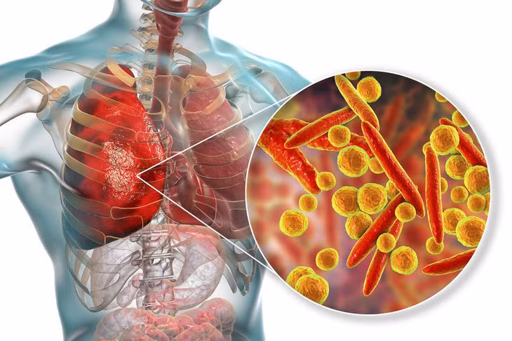 Bác sĩ cảnh báo bệnh do vi khuẩn Mycoplasma nếu không được phát hiện và điều trị đúng cách sẽ gây ra những biến chứng nguy hiểm cho người bệnh và có thể lây lan rộng ra cộng đồng - Ảnh: BVCC
