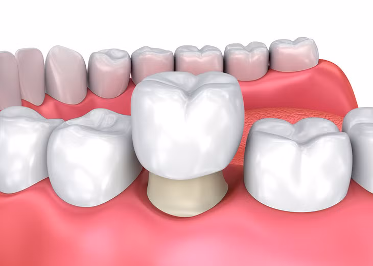 Bọc răng sứ có thể cải thiện các khiếm khuyết của miệng, đồng thời giúp có hàm răng đẹp hơn.