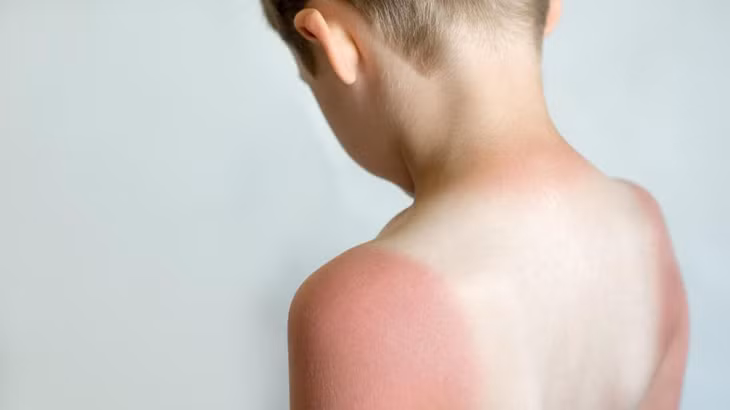 Cháy nắng ở trẻ gây ra các mảng phát ban đỏ rộng (Ảnh: ST)