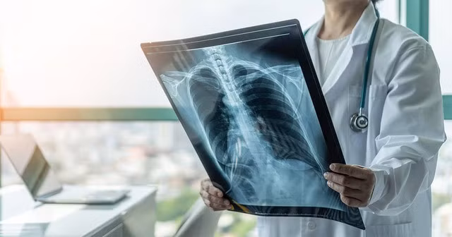 Viêm phế quản nếu tự ý điều trị sai cách có thể dẫn tới những biến chứng nguy hiểm.