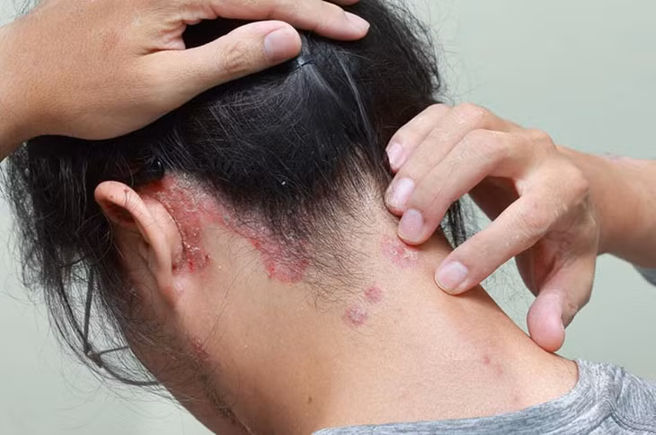 Thường xuyên đội mũ bảo hiểm ẩm, không được vệ sinh sạch sẽ hoàn toàn có thể gây ra tình trạng ngứa đầu, rụng tóc nhiều, nấm đầu. Ảnh minh họa