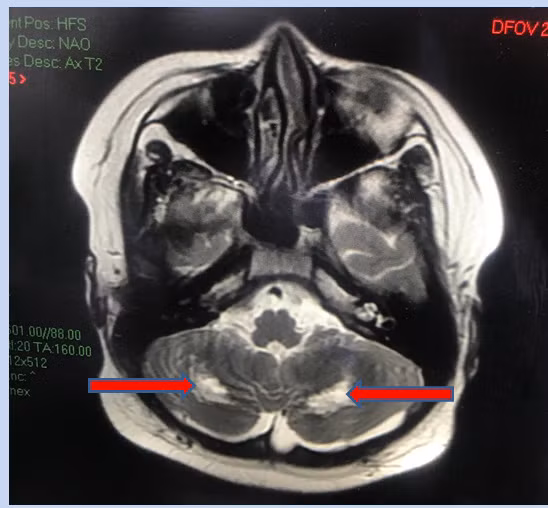 Hình ảnh cộng hưởng từ (MRI) não của bé T.G.H. (13 tuổi) cho thấy tổn thương chất trắng vùng tiểu não hai bên, gây hiện tượng rối loạn phối hợp vận động, loạng choạng... Ảnh: BVCC