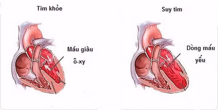 Suy tim khiến người bệnh luôn mệt mỏi, khó thở.