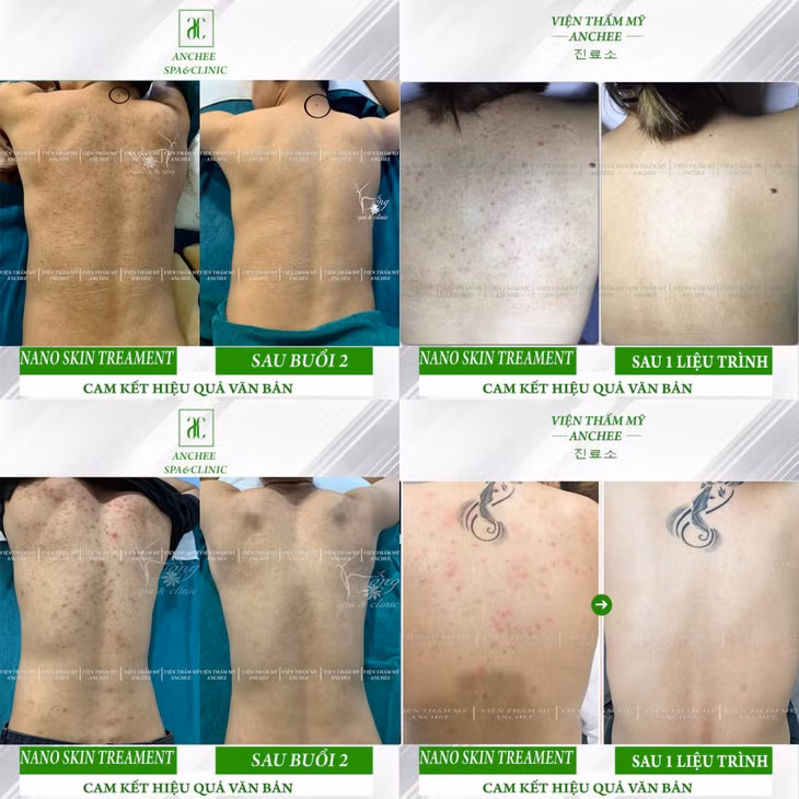 5 cách trị mụn lưng nam giới tại nhà hiệu quả ảnh 1