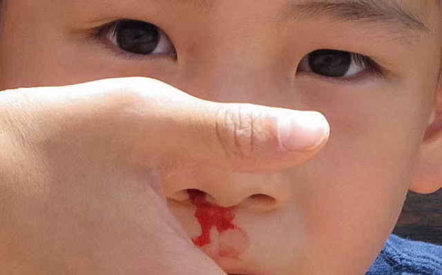Chảy máu cam là tình trạng thường gặp ở trẻ nhỏ.