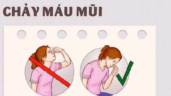 Vách ngăn mũi bị vẹo là một trong những nguyên nhân gây chảy máu cam ở trẻ.