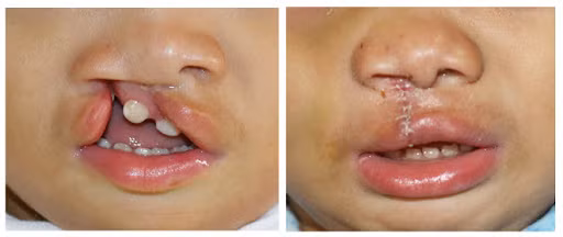 Hình ảnh trẻ trước và sau phẫu thuật dị tật khe hở môi.