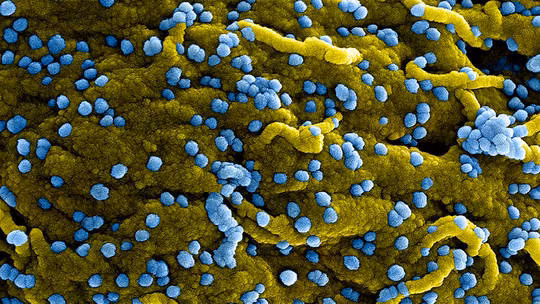 Hình ảnh hiển vi điện tử quét màu của các hạt virus Marburg (màu xanh lam) dính vào bề mặt của các tế bào VERO E6 bị nhiễm bệnh (màu vàng). Ảnh: Getty Images