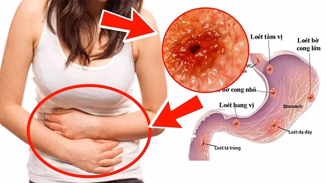 Viêm loét dạ dày - tá tràng gây những cơn đau khó chịu.