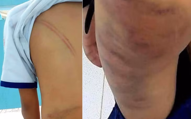 Hình ảnh cháu T. bị mẹ kế đánh bầm tím người.