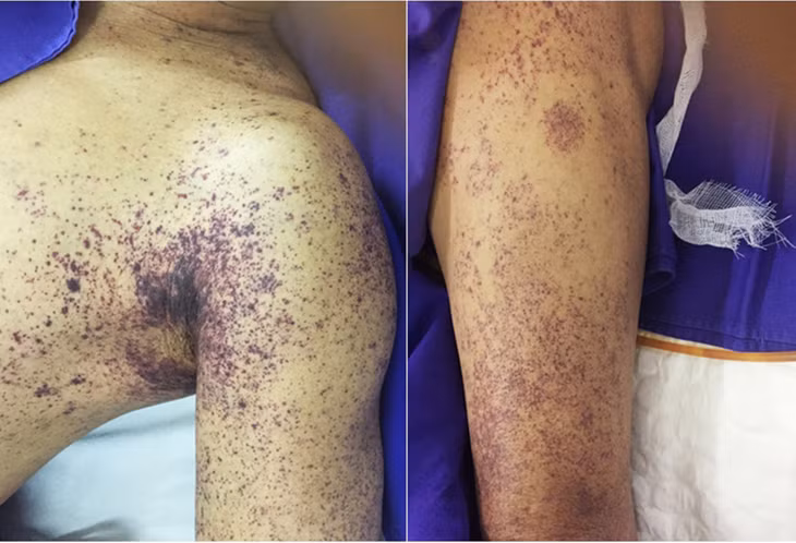 Bệnh nhân nhiễm liên cầu khuẩn lợn bị ban xuất huyết hoại tử rải rác khắp cơ thể. (Ảnh minh họa)