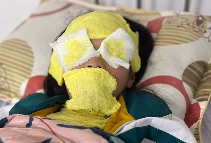 Bé gái bị bỏng độ II tại mặt, cổ (Ảnh: BVCC).