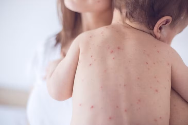 Sốt xuất huyết có thể gây biến chứng nặng nếu không được điều trị kịp thời.