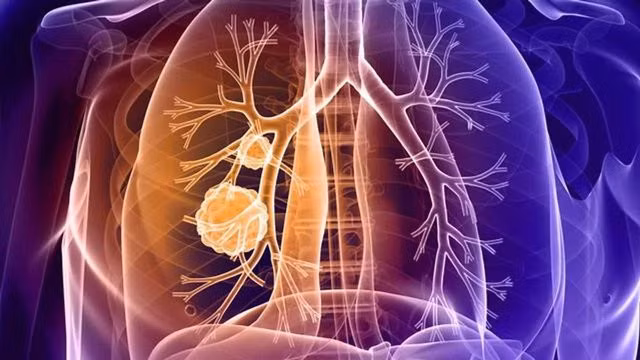 Nếu không phát hiện và điều trị kịp thời, ung thư phổi có thể lan rộng sang các bộ phận khác trong cơ thể và dẫn đến tử vong