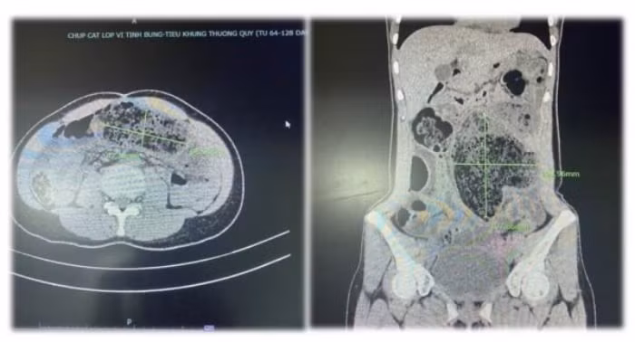 Kết quả chụp hình ảnh Cắt lớp vi tính (CT-Scan) phát hiện đoạn ruột phình to chứa nhiều bã thức ăn. (Ảnh: BVCC)