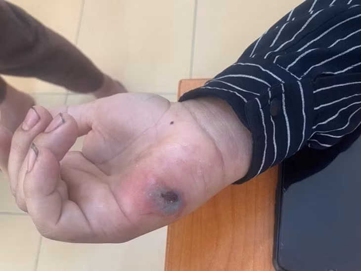 Biểu hiện bệnh than trên người đang được điều trị - Ảnh: CDC tỉnh Điện Biên