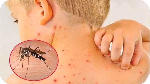 Bộ Y tế đề nghị các tỉnh, thành phát động các chiến dịch diệt muỗi, diệt lăng quăng phòng chống sốt xuất huyết, đồng thời tăng cường phòng chống bệnh dịch mùa hè