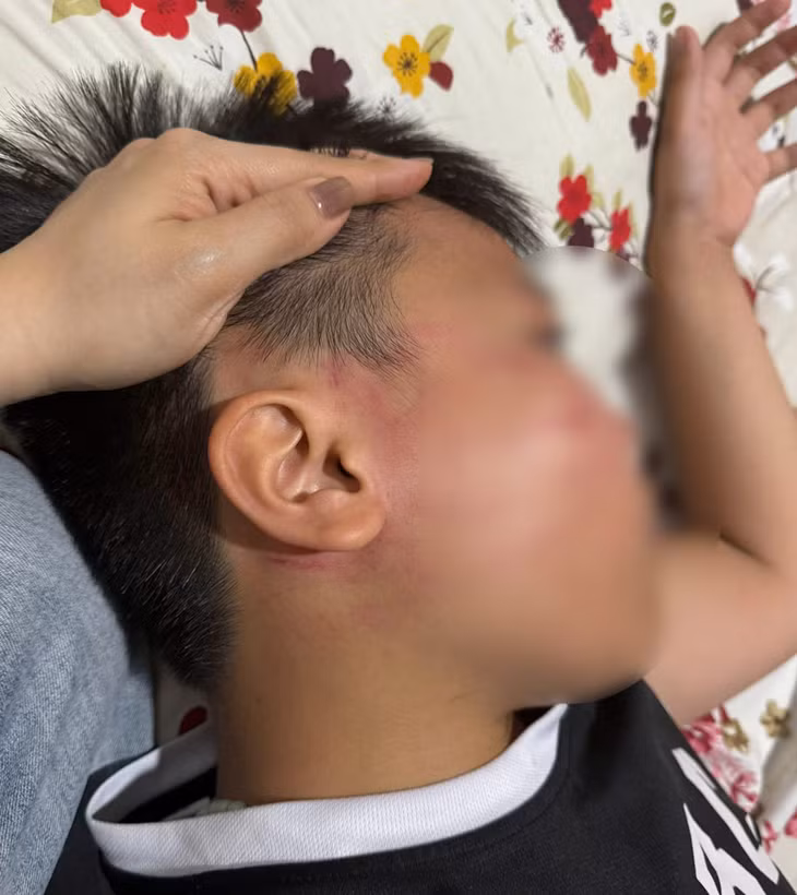 Vùng má, tai cháu V. xuất hiện nhiều vết bầm đỏ. Ảnh: Gia đình cung cấp