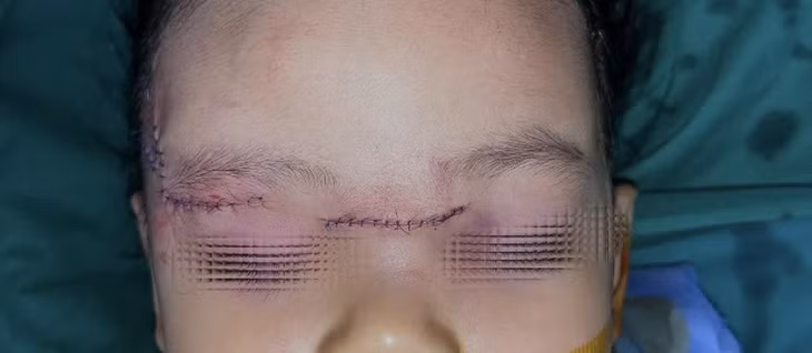 Bé được xử lý vết thương vùng mặt sau tai nạn chó cắn - Ảnh: BVCC