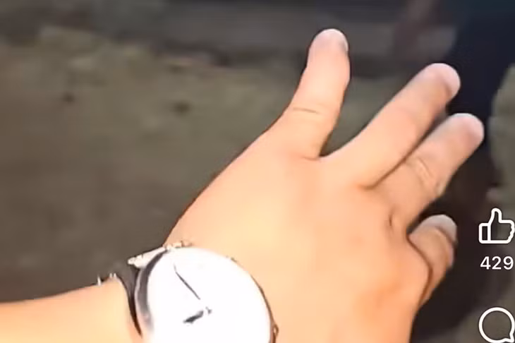 Ngón tay út của vị khách bị lệch, gãy sau vụ việc. Ảnh cắt từ clip