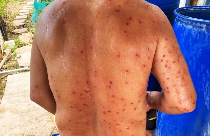 Vùng lưng ông D. bị ong vò vẽ đốt nhiều vết trong lúc đi câu cá - Ảnh: Người dân cung cấp
