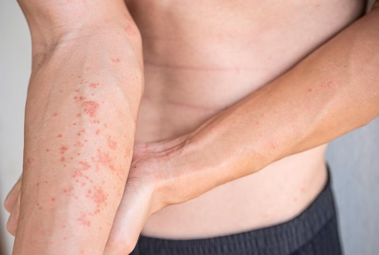 Viêm da tiếp xúc dị ứng là tình trạng da bị viêm khi tiếp xúc với các tác nhân gây kích ứng như hóa chất, nước bẩn…