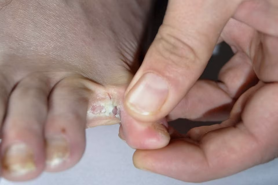 Các mảng đau và bong tróc ở bàn chân khi bị nấm kẽ chân (nước ăn chân). Ảnh: NHS.