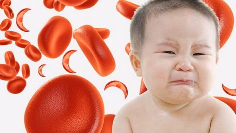Thiếu sắt có thể ảnh hưởng nghiêm trọng đến sức khỏe và sự phát triển trí não của trẻ.