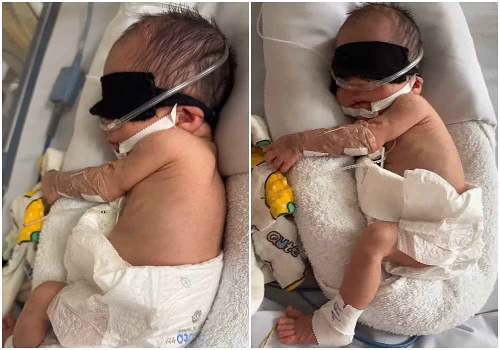 Trẻ sinh non 31 tuần tuổi bị suy hô hấp, bệnh màng trong được các bác sĩ Bệnh viện Đa khoa tỉnh cấp cứu, điều trị tích cực. Ảnh: Hà Trang