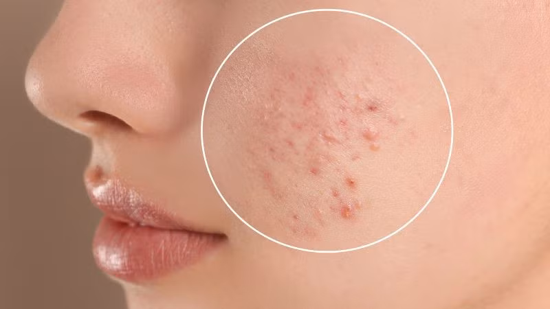 Da khô, viêm da, mụn ,...có thể do thiếu vitamin