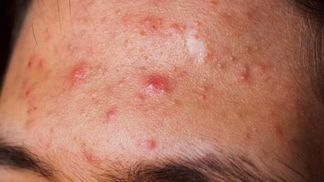 Dùng mỹ phẩm thường xuyên khiến chị em dễ bị dị ứng, nhất là trong mùa hè, thời tiết nóng nực và mồ hôi tiết ra nhiều