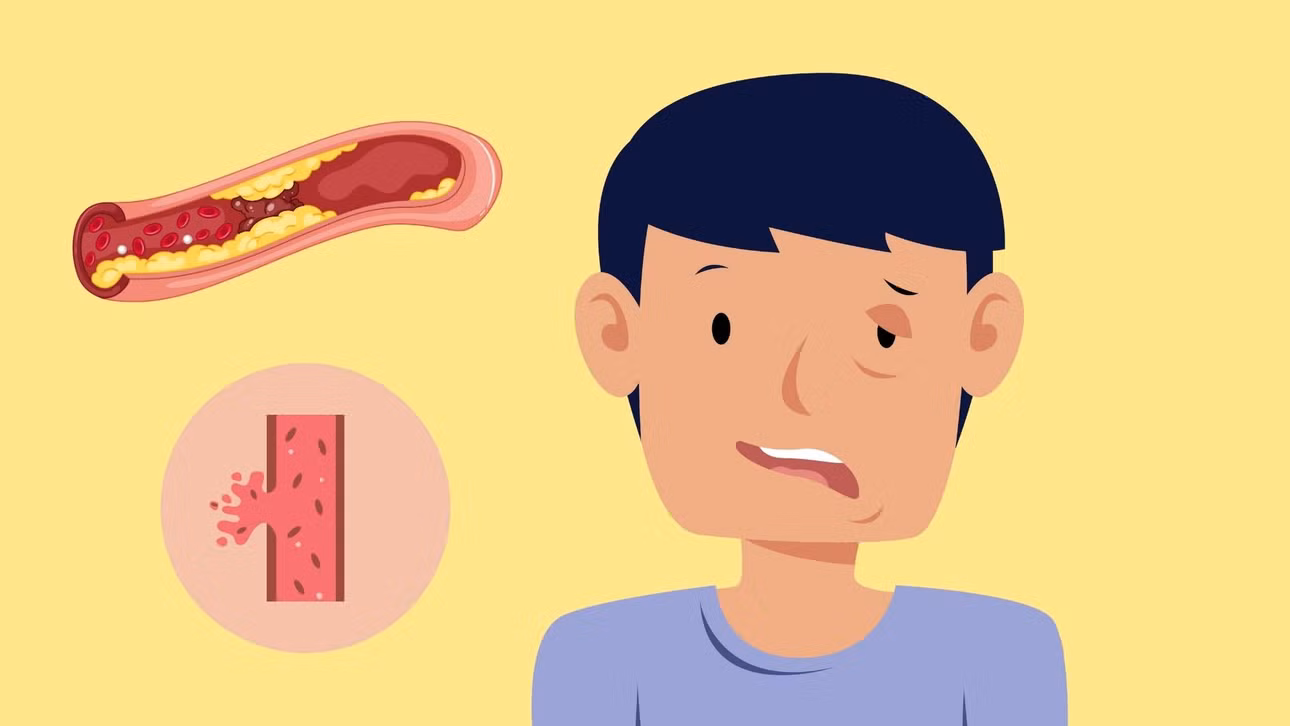 Lối sống hiện đại và sự gia tăng đột quỵ ở giới trẻ. Đồ họa: Minh Hoàng