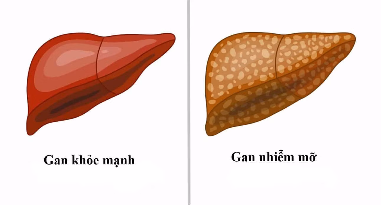 Gan nhiễm mỡ: Nguyên nhân, biểu hiện, điều trị và phòng bệnh