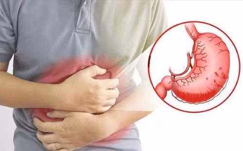 Chất chua trong dưa hành muối có thể gây tổn thương niêm mạc dạ dày, làm chậm quá trình lành vết loét.