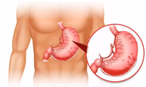 Điểm mặt các dấu hiệu bất thường về đau dạ dày cần tới bác sĩ