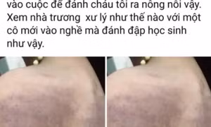 Tạm đình chỉ công tác cô giáo đánh bầm vai, lưng học sinh lớp 3