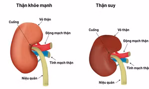 Bác sĩ chỉ 4 dấu hiệu suy thận ở người trẻ dễ bỏ qua