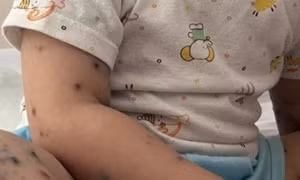 Vaccine phòng tay chân miệng được cấp phép tại Việt Nam