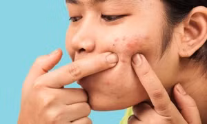 6 thói quen xấu gây mụn trứng cá
