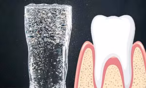 Nước khoáng có ga và nguy cơ bào mòn men răng