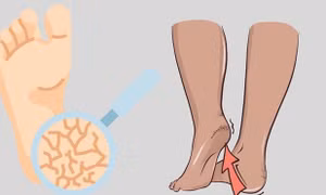 3 bước chăm sóc gót chân trong những ngày hanh khô