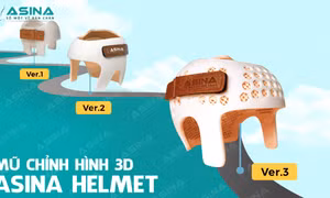 Đầu bẹp ở trẻ sơ sinh: Liệu có tự hết khi lớn lên?