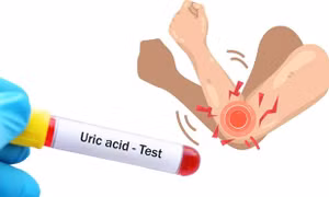 Dấu hiệu cảnh báo axit uric cao đang tấn công khớp