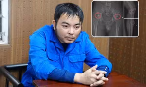 Cựu nhân viên y tế đục vỡ xương bệnh nhân nhằm chiếm đoạt hàng tỉ đồng bảo hiểm