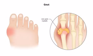 Thiếu vitamin D có thể gây tăng axit uric