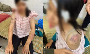 Bé gái bị bạo hành dã man tại Thái Nguyên