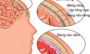 Não mô cầu: Căn bệnh có thể gây nguy kịch trong vài giờ