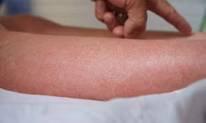 5 bệnh dễ mắc vào mùa mưa