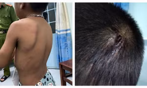 Bé trai 6 tuổi bị cha ruột hành hạ, đánh đập dã man